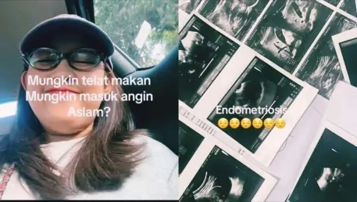 Viral: Wanita 20-an Mengalami Endometriosis, Bukan Asam Lambung
