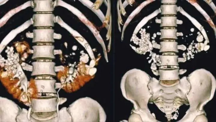 Pria 35 Tahun Terpaksa Hadapi Ratusan Batu Ginjal