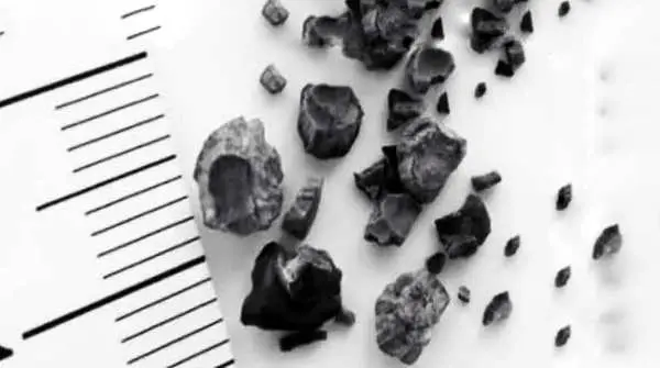 Kisah 3 Penderita Batu Ginjal: Gejala Awal, Pengobatan, & Pencegahan